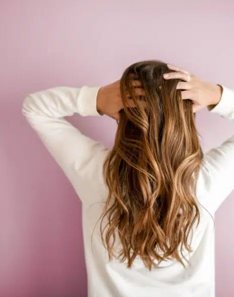 alopecia