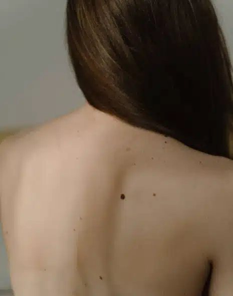 Tratamientos estéticos para eliminar los lunares o nevus